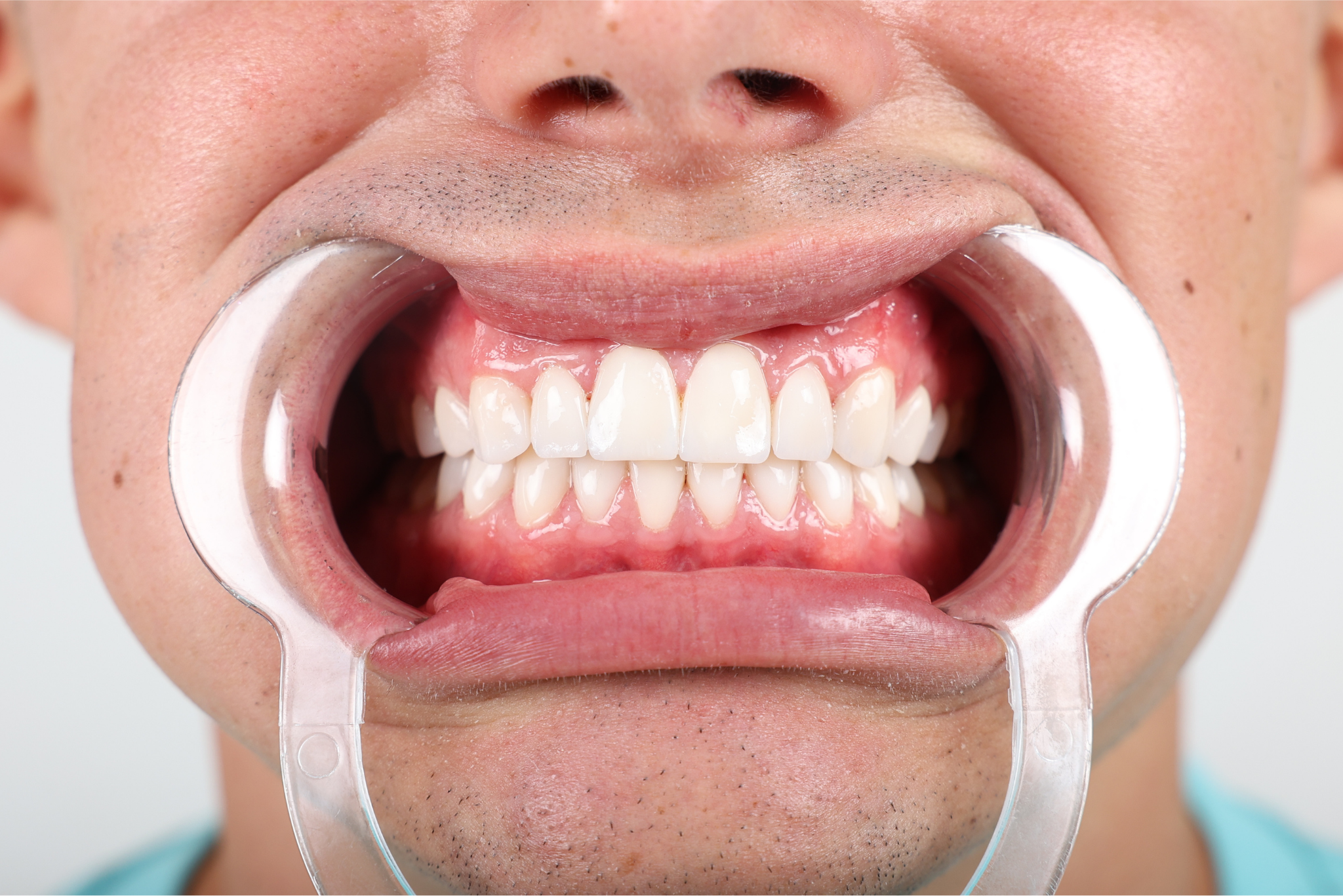 After E-max Laminate Treatment